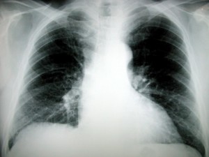 Chest Xray